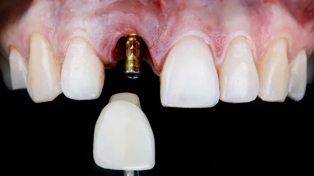 Dental Implants Sutton